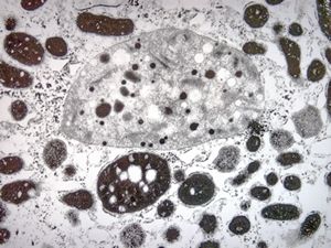 F,17y. | megamitochondria - Wilson disease F,17y. | megamitochondria - Wilson disease